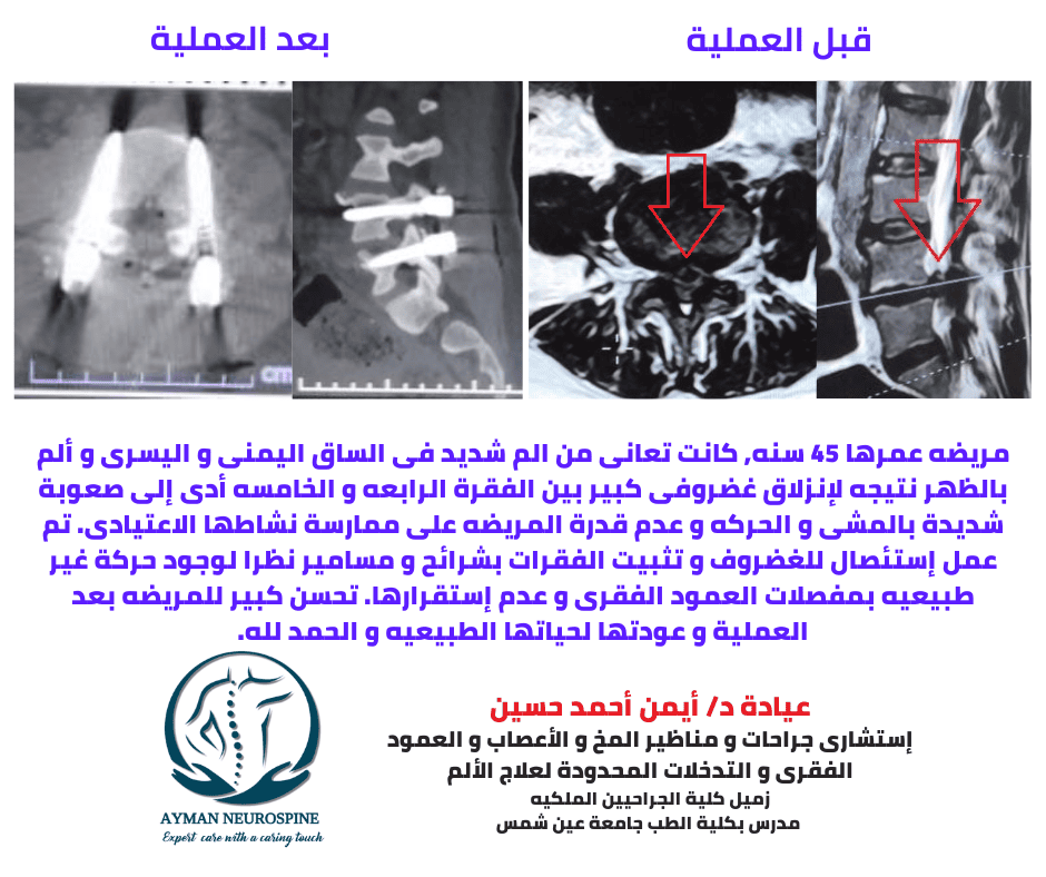 عمليه عمود فقرى - انزلاق غضروفى قطنى