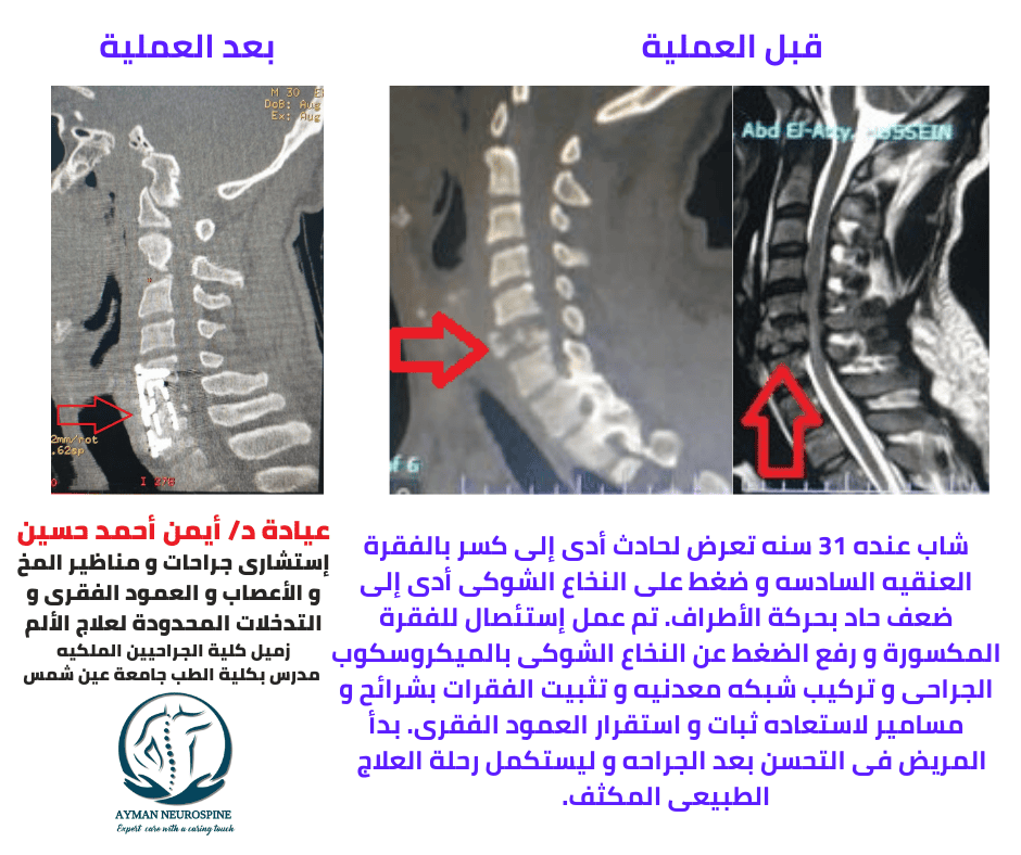 عمليه عمود فقرى - كسر بالفقرات العنقيه