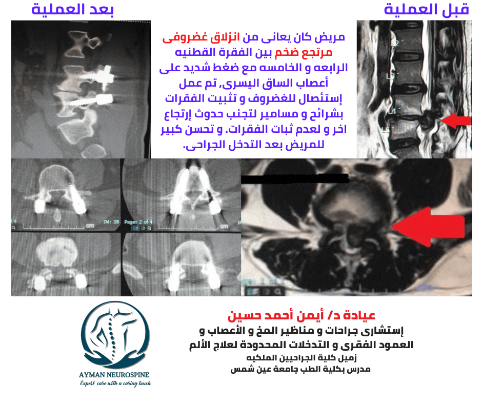 عمليه عمود فقرى - انزلاق غضروفى قطنى