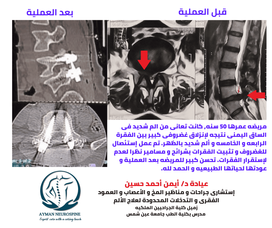 عمليه عمود فقرى - انزلاق غضروفى قطنى