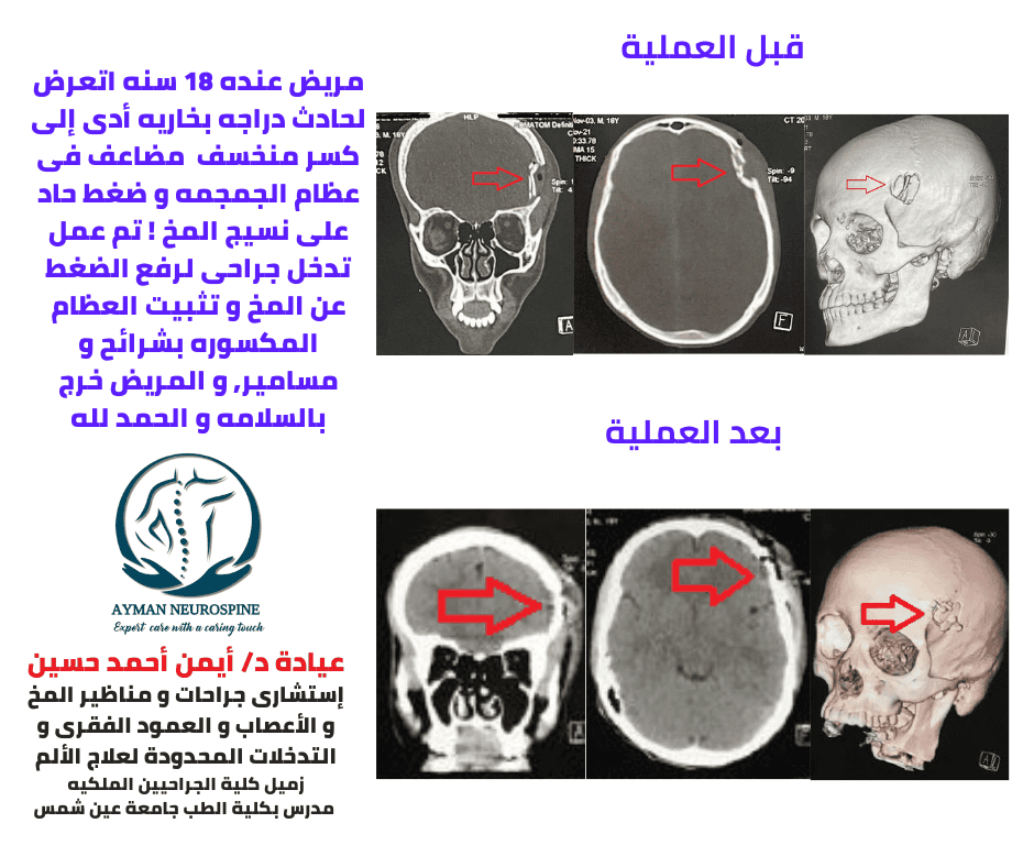 اصلاح كسر بالجمجمه - عيادة د أيمن أحمد حسين - أفضل دكتور جراحه مخ و أعصاب و عمود فقرى و علاج الألم