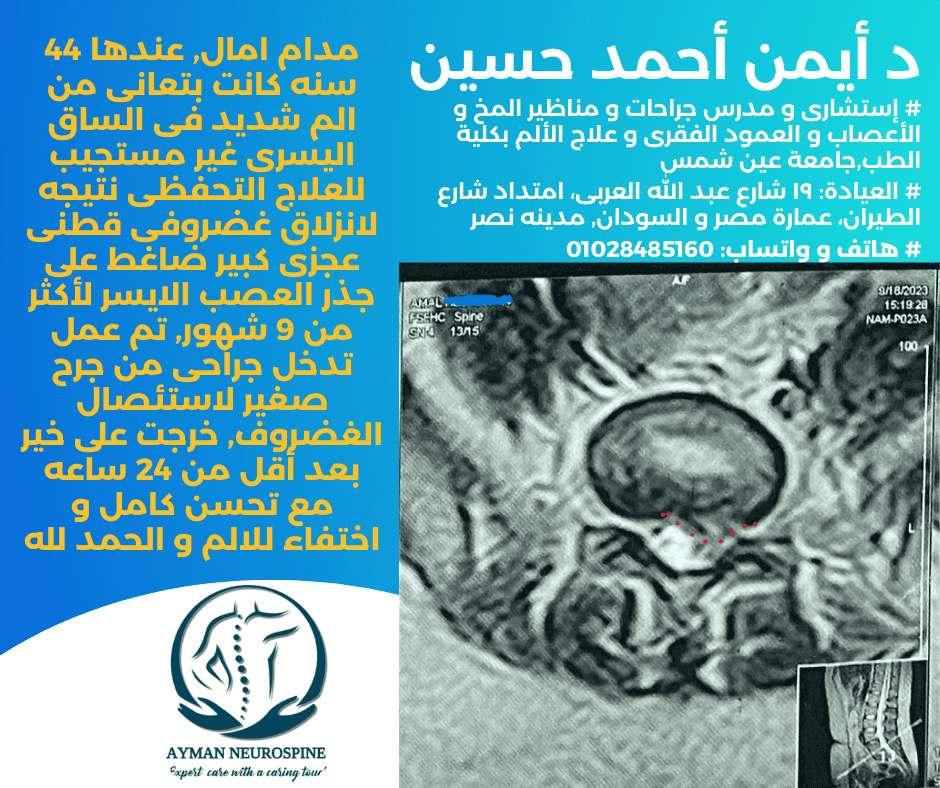 استئصال غضروف قطنى