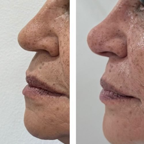 antes_y_despues_nariz