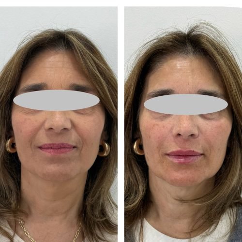 muestra_resultado_labios