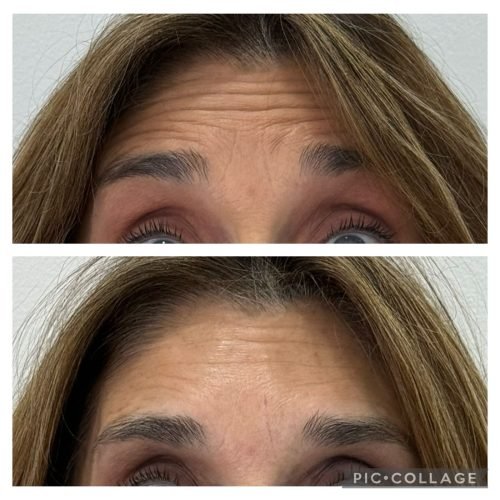 muestra_resultado_botox