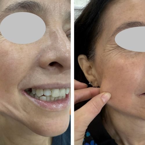 muestra_resultado_bioestimulador_de_colageno