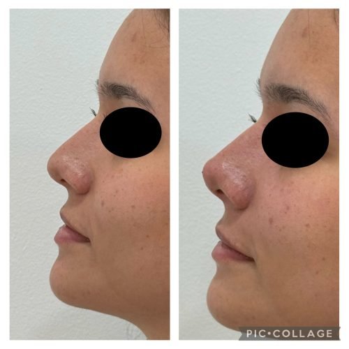 antes_y_despues_nariz_menton