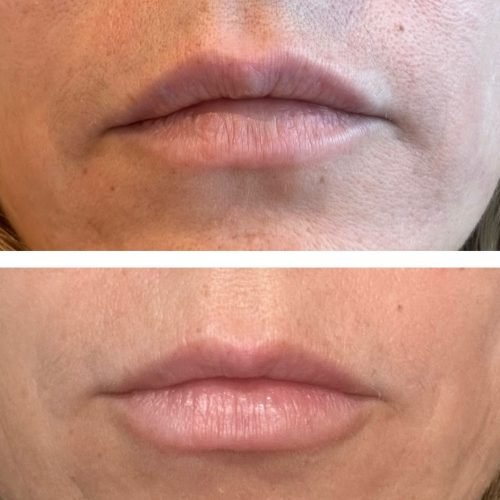 muestra_relleno_de_labios