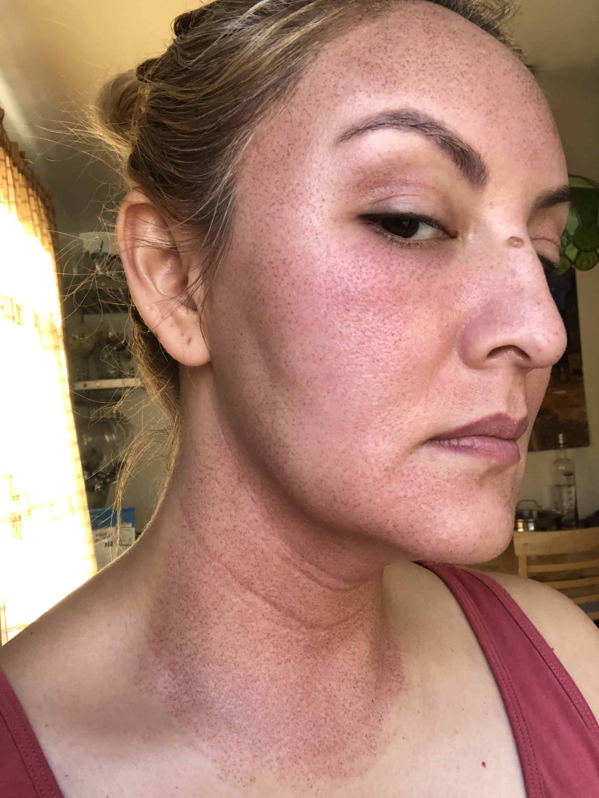 Halo Laser Treatment Before and After Photos Fresh Face + Eye