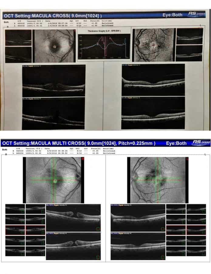 Lupe — OCT eye scan comparison, Makari Wellness