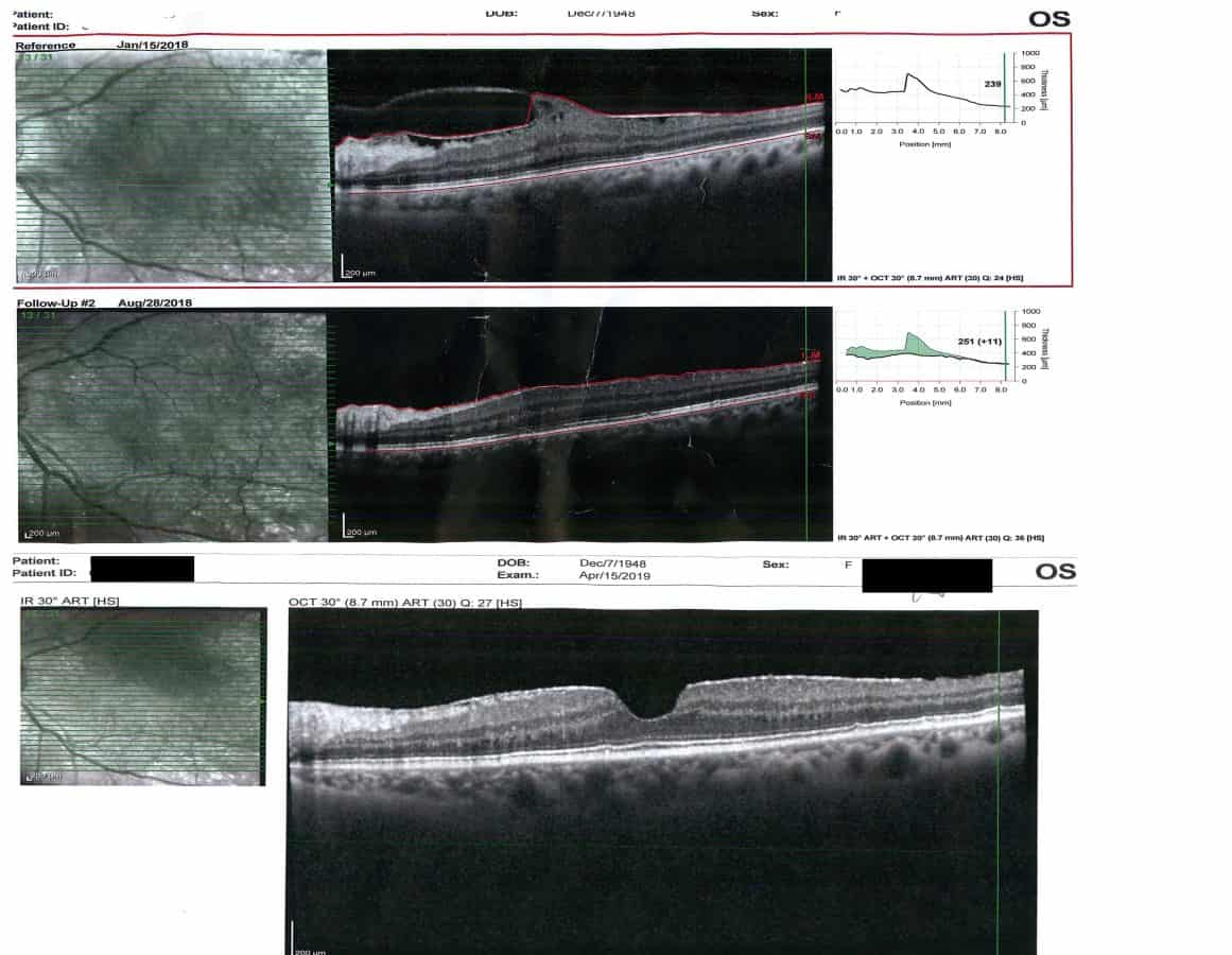 Paulette — eye progress OCT scan, Makari Wellness