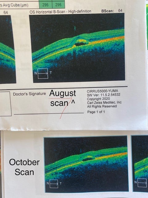 Macular degeneration OCT scan — Makari Wellness