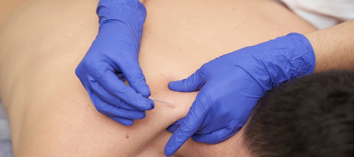 Dry needling vs acupuncture — acupuncture treatment at Makari Wellness