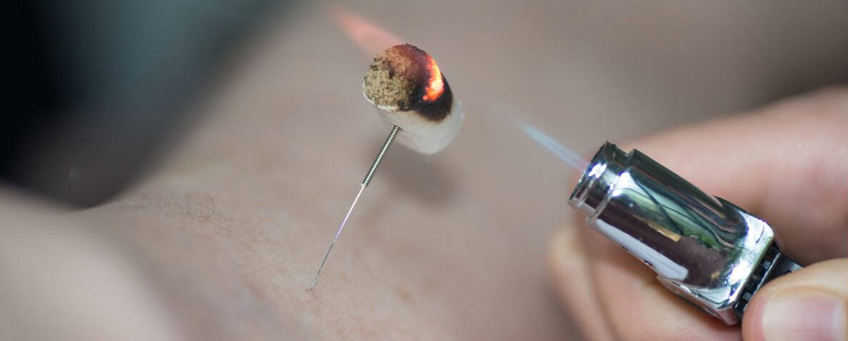 Electroacupuncture treatment san diego — acupuncture treatment at Makari Wellness