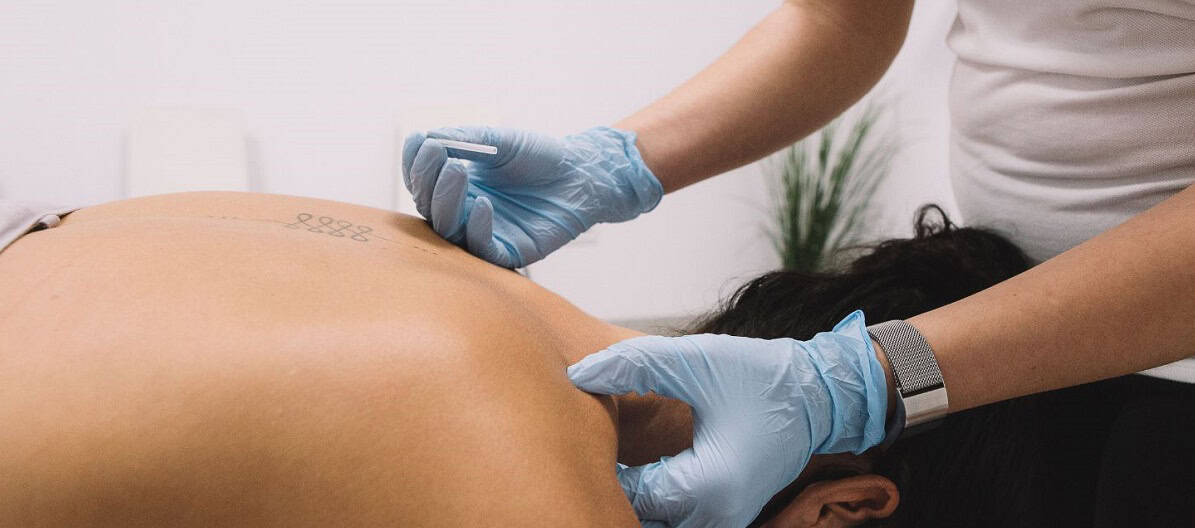 Needling — Makari Wellness