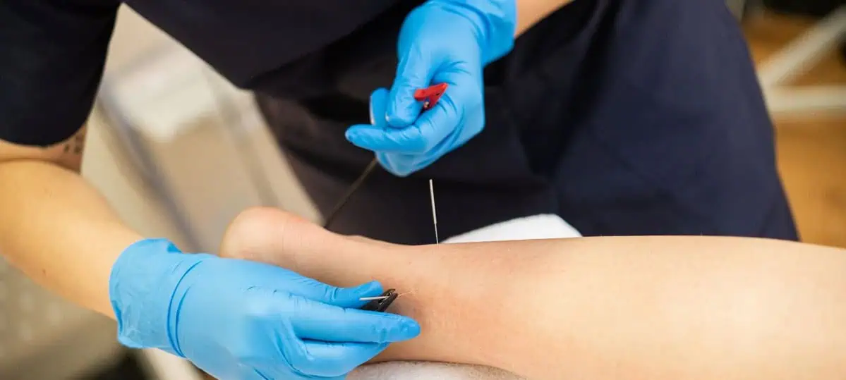 What is dry needling — Makari Wellness