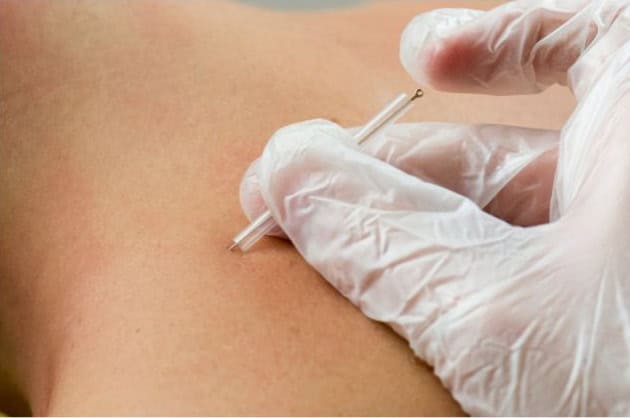 Dry needling san diego — Makari Wellness