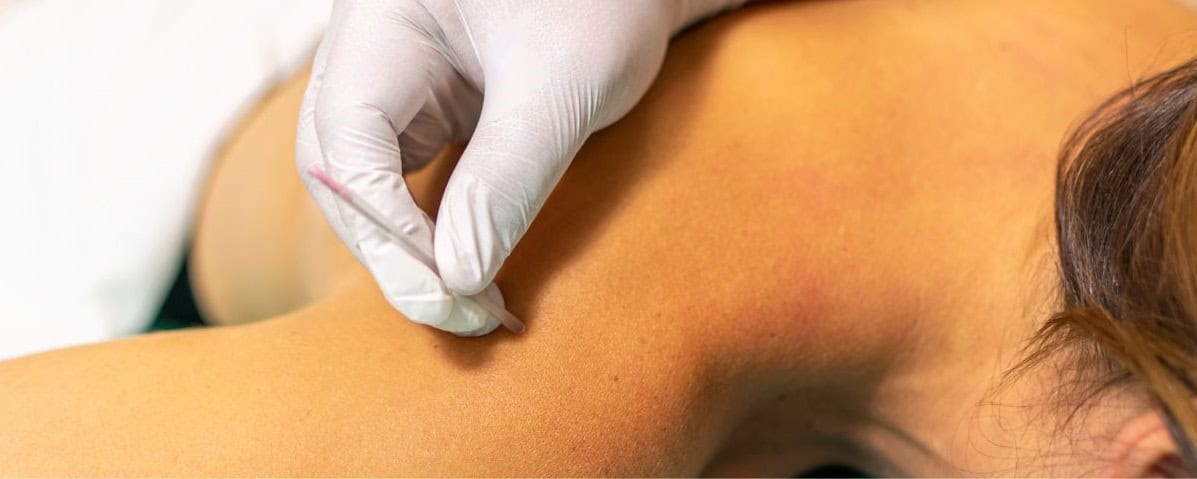 San diego ca orthopedic acupuncture clinic — acupuncture treatment at Makari Wellness