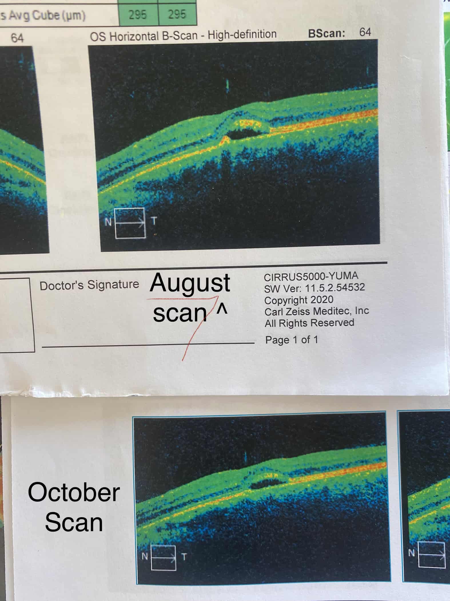 CST and macular degeneration OCT scans — Jillian, before and after treatment at Makari Wellness