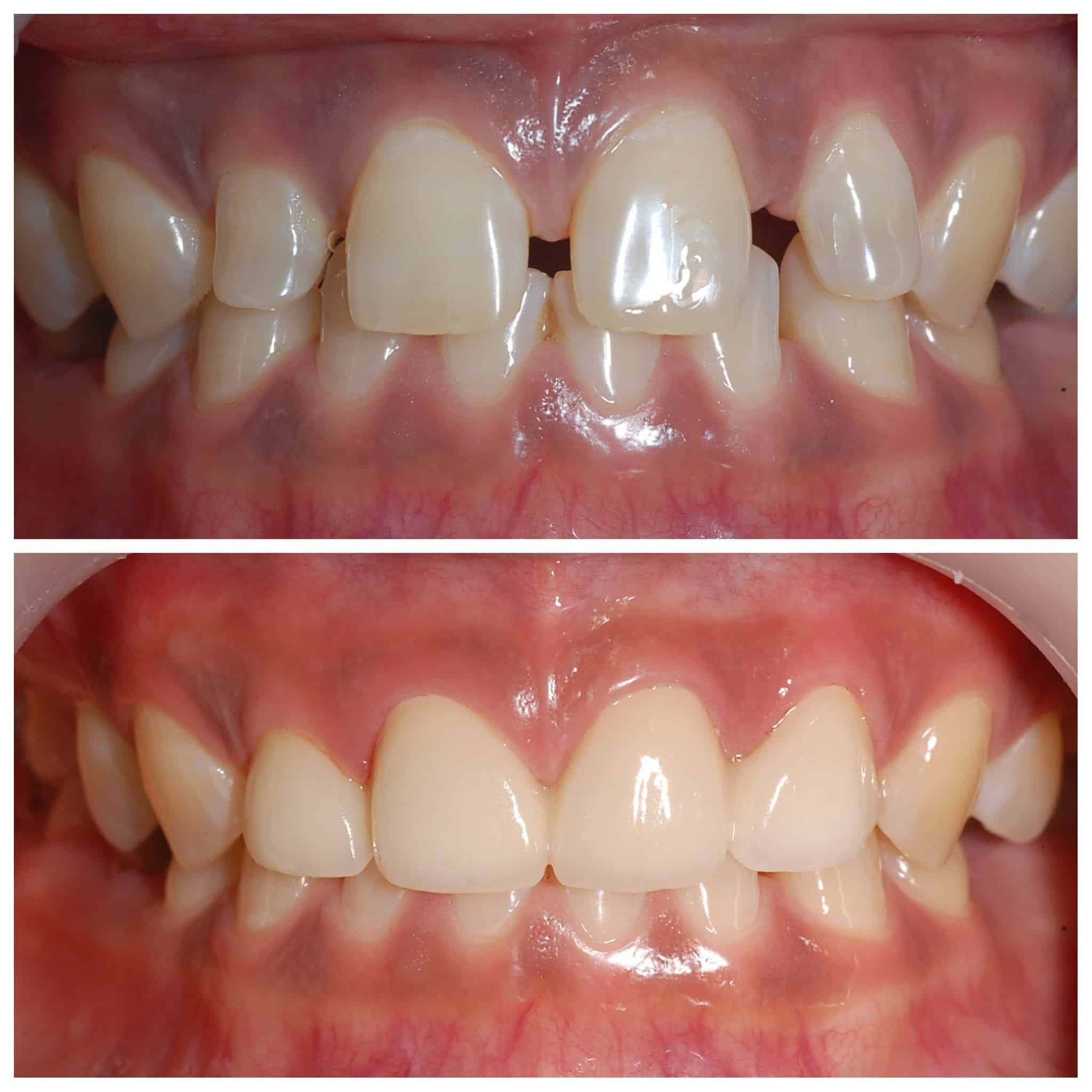 벌어진치아 올세라믹 전후