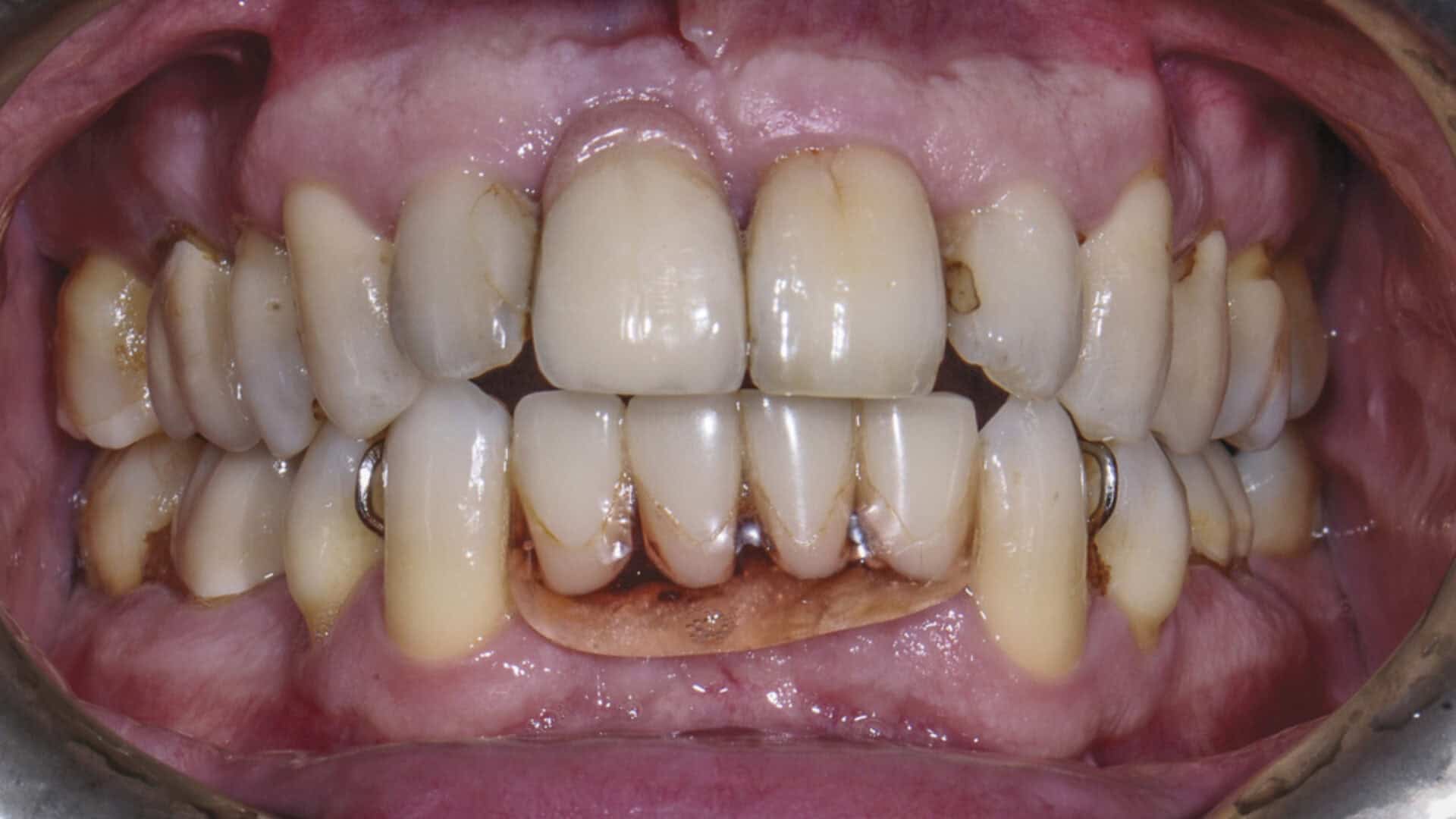 전체임플란트 전