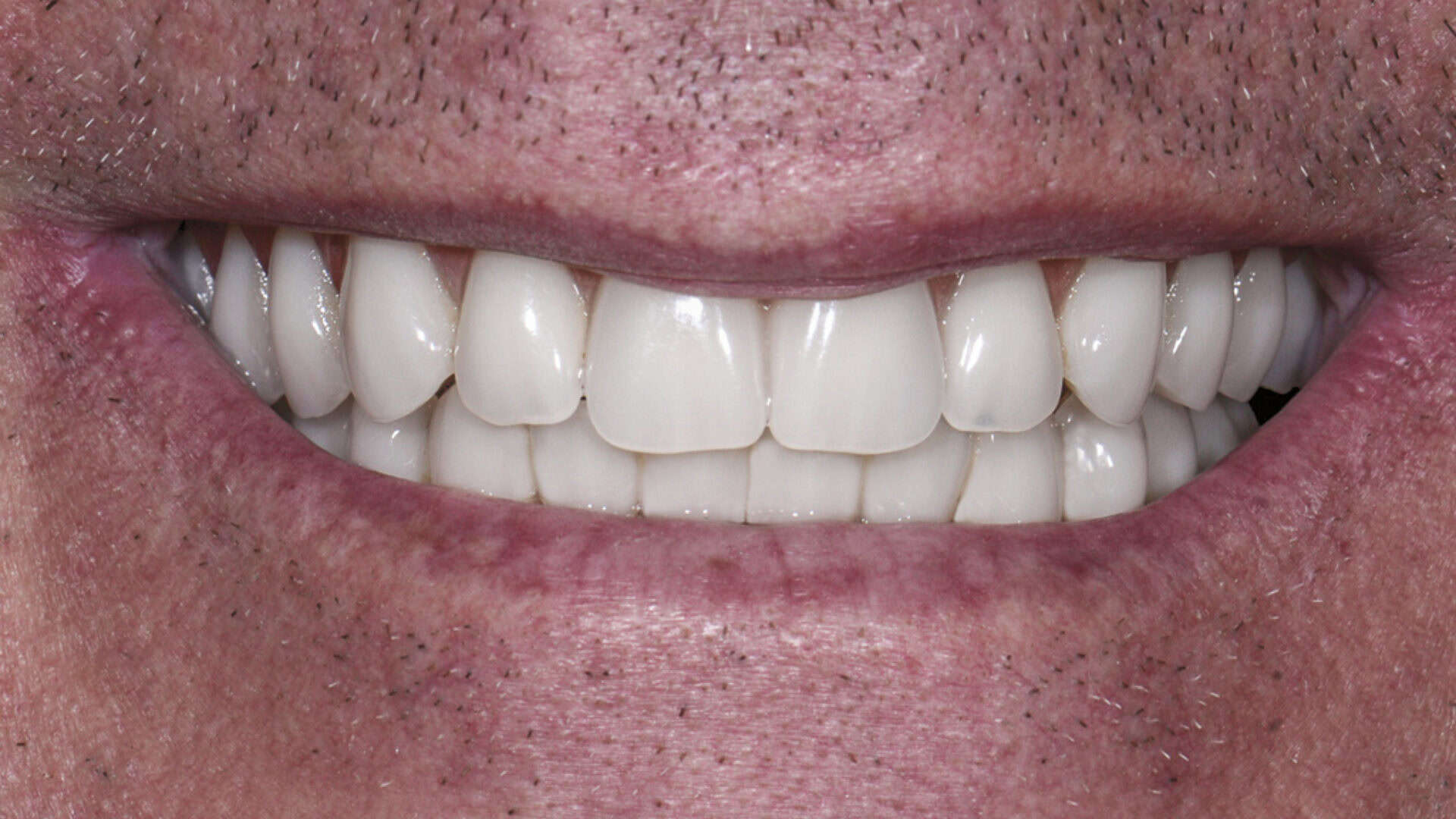 전체임플란트 후