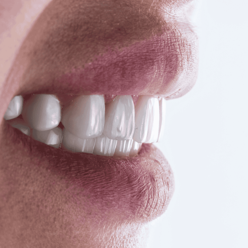 노원 앞니크라운